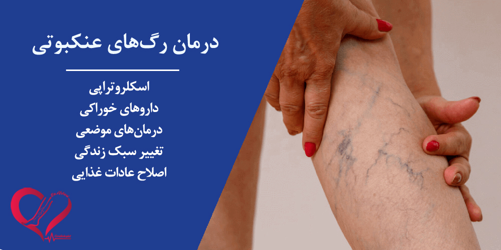 درمان واریس عنکبوتی