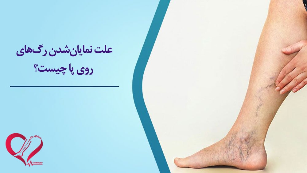 علت نمایان‌شدن رگهای پا