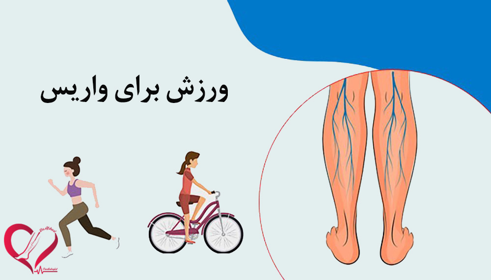 ورزش برای واریس