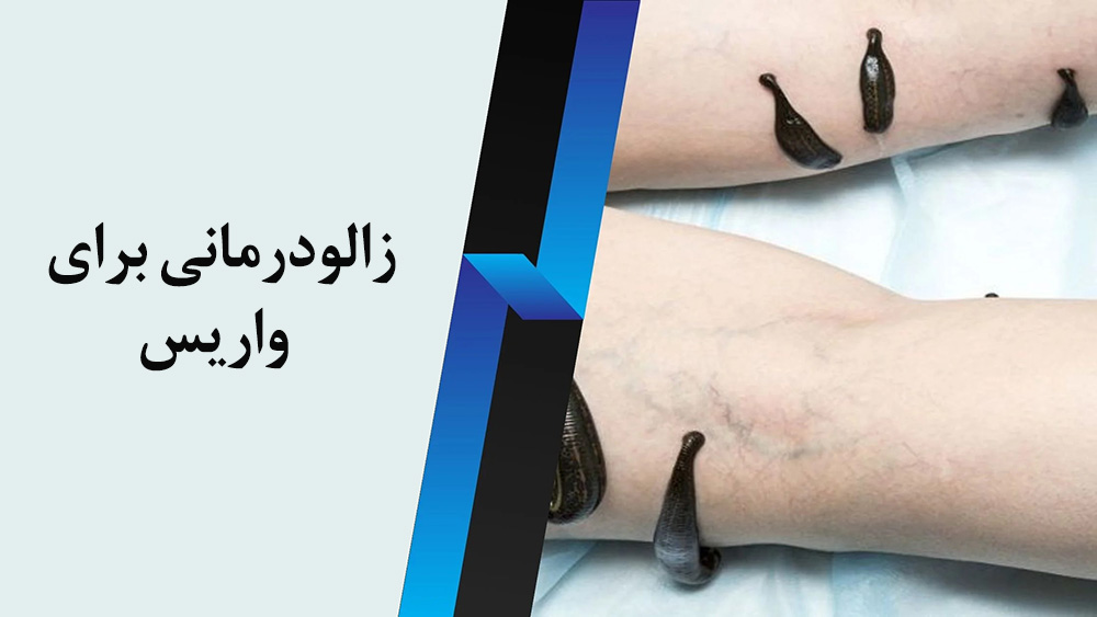 زالودرمانی برای واریس