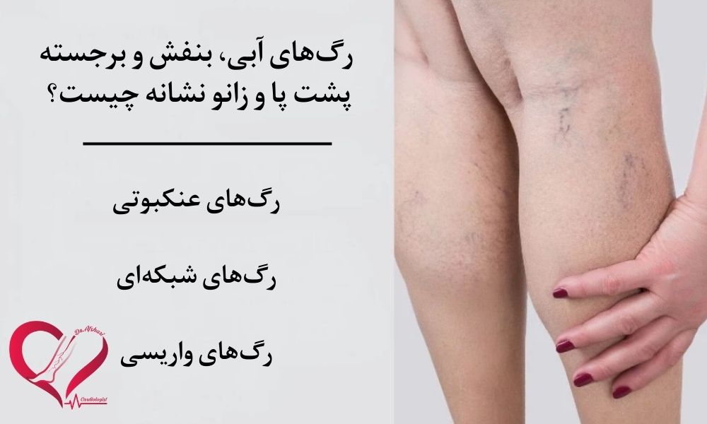 رگ_های آبی، بنفش و برجسته پشت پا و زانو؛ علت_ها، انواع و روش تشخیص دقیق