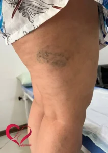 99
