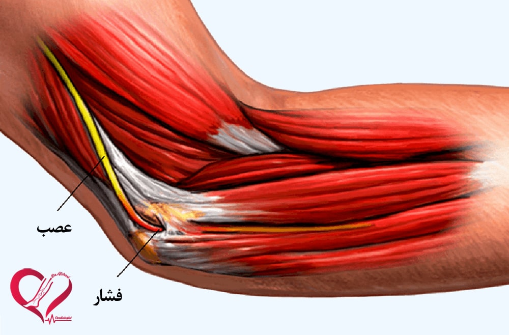 فشار روی عصب یا رگ