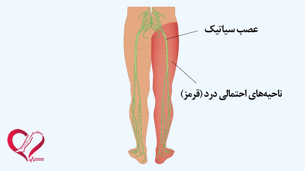 سیاتیک