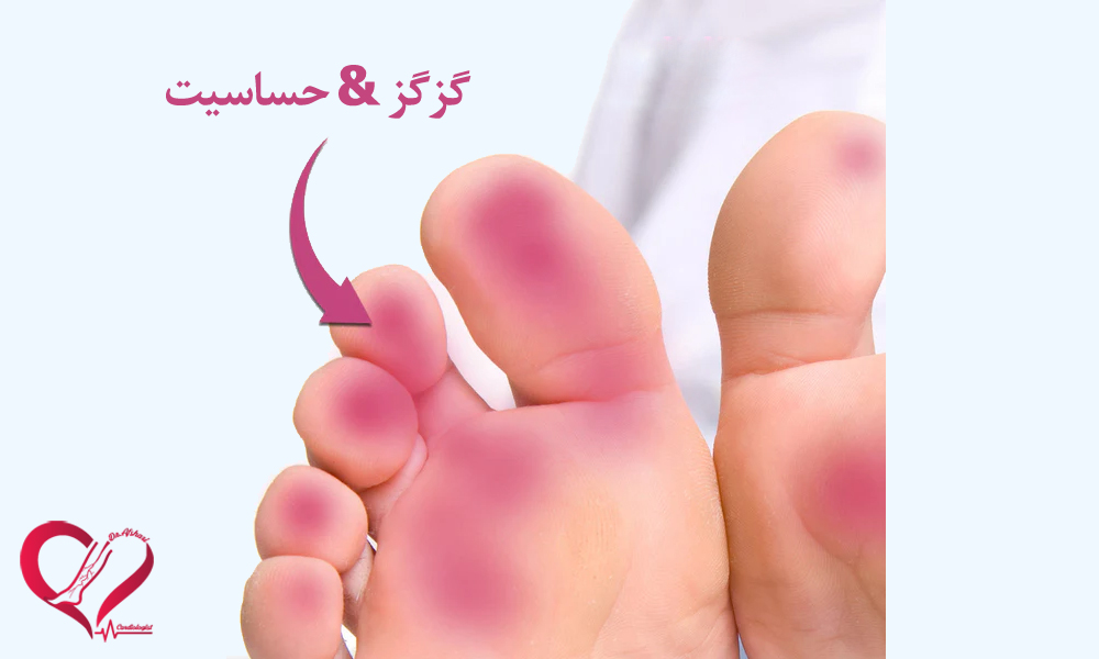 گزگز & حساسیت