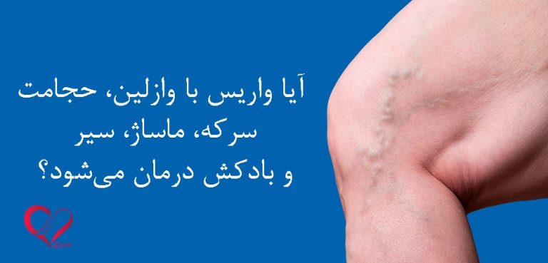 بررسی علمی درمان واریس