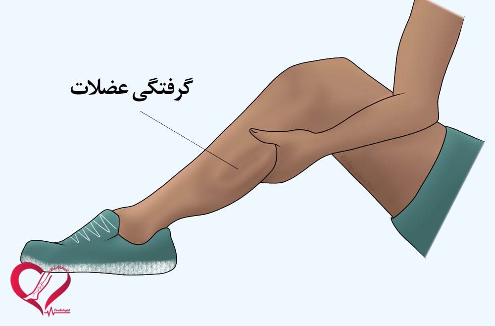 گرفتگی عضلانی 