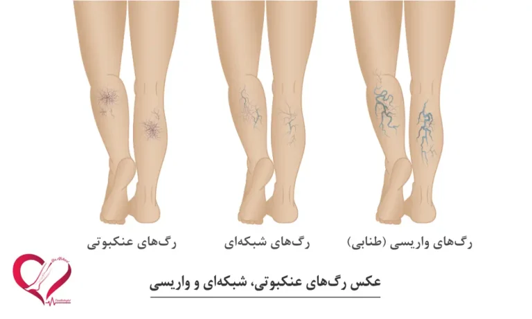 تصویر واریس پا
