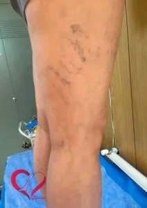 varicose1
