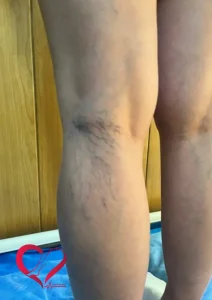 varicose2