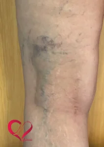 varicose4