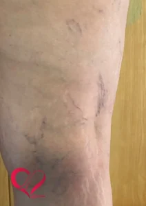 varicose5
