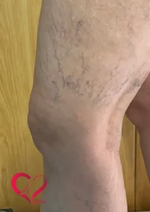 varicose6