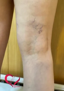 varicose7