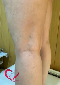 varicose8