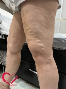 varicose91