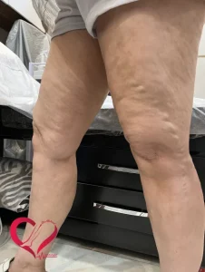 varicose92
