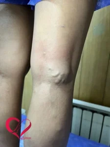 varicose94