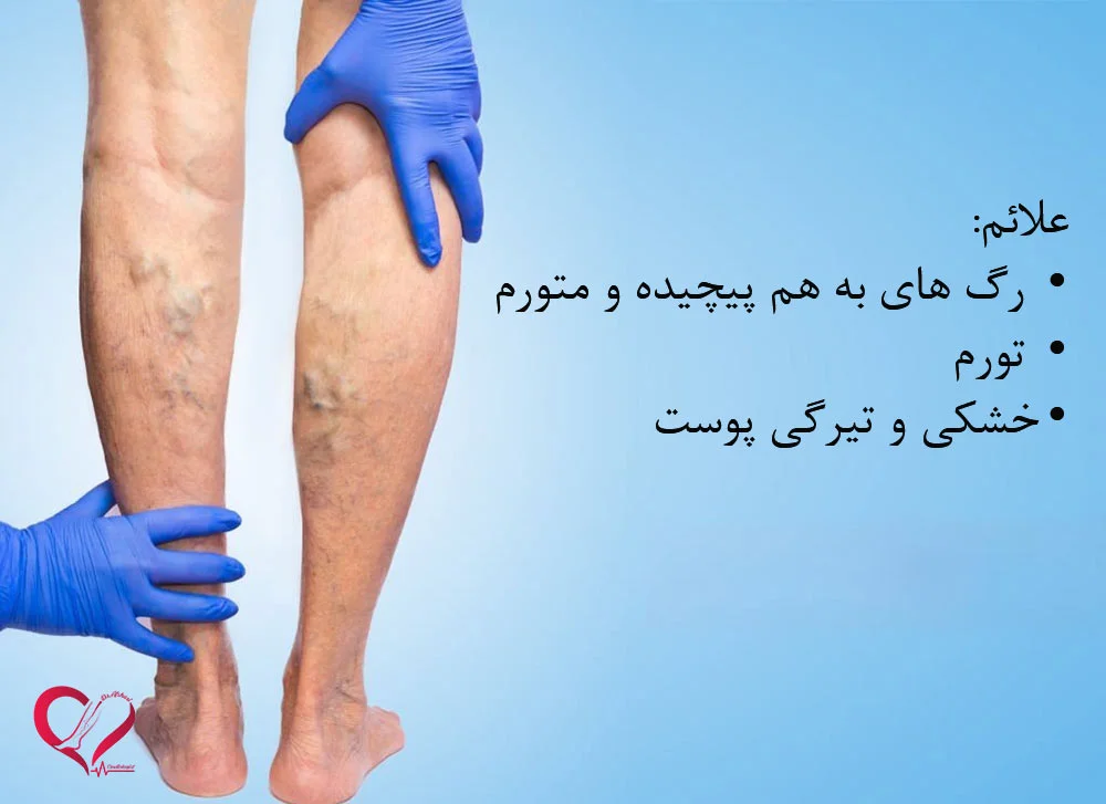 نشانه های واریس پیش‌رونده