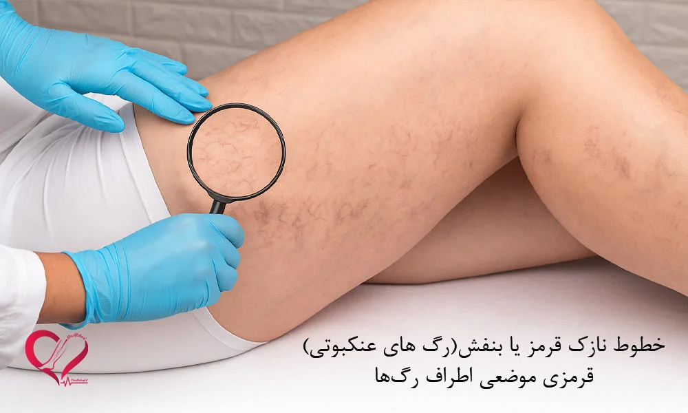 نشانه های بروز واریس خفیف