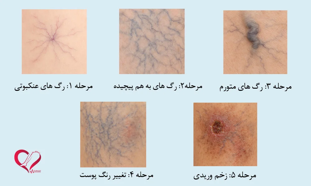 واریس چه نشانه هایی دارد