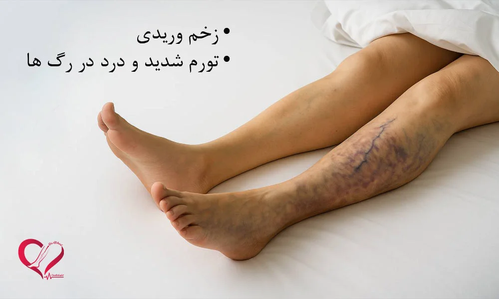 علائم واریس خطرناک