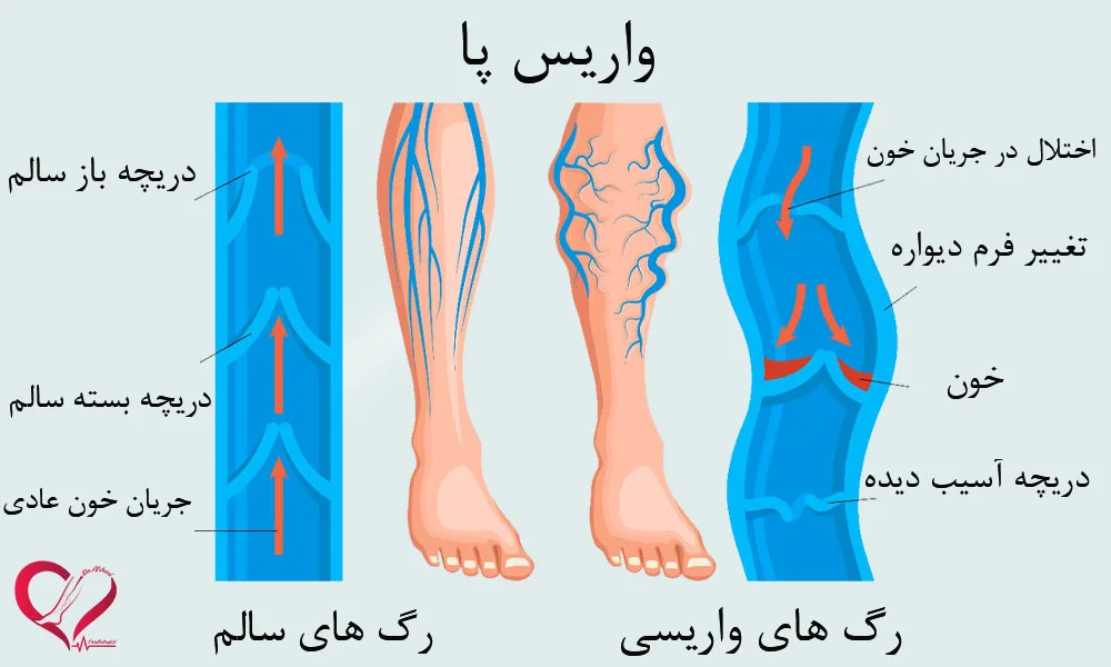 واریس پا