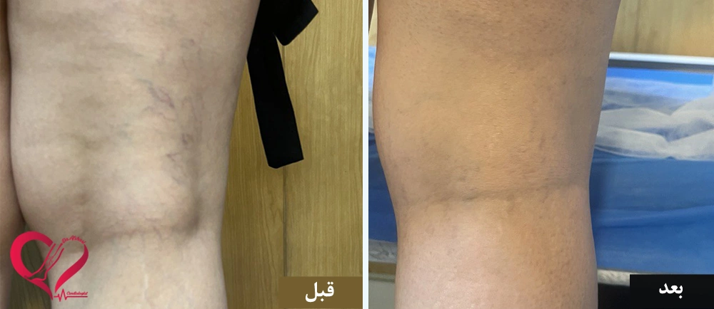 اسکلروتراپی تلانژکتازی