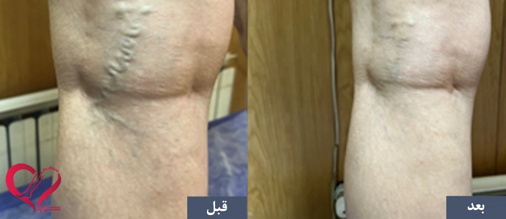 اسکلروتراپی تلانژکتازی