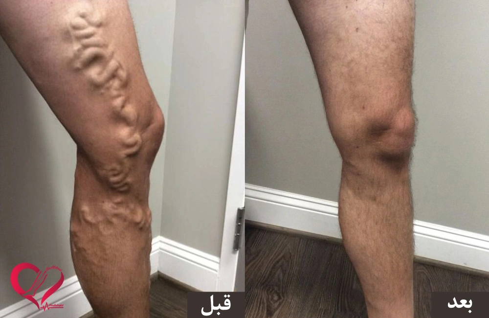 واریس رگ‌های طنابی