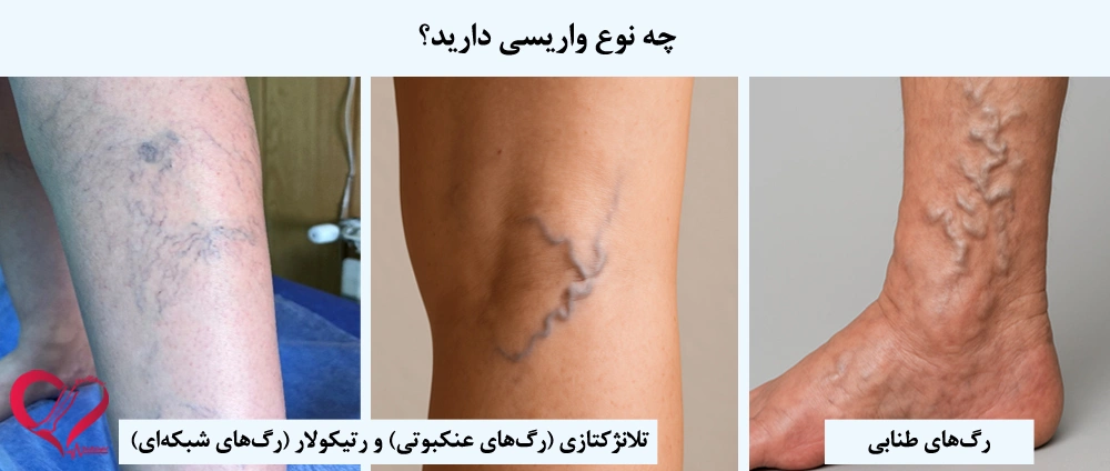 رگ‌های واریسی 