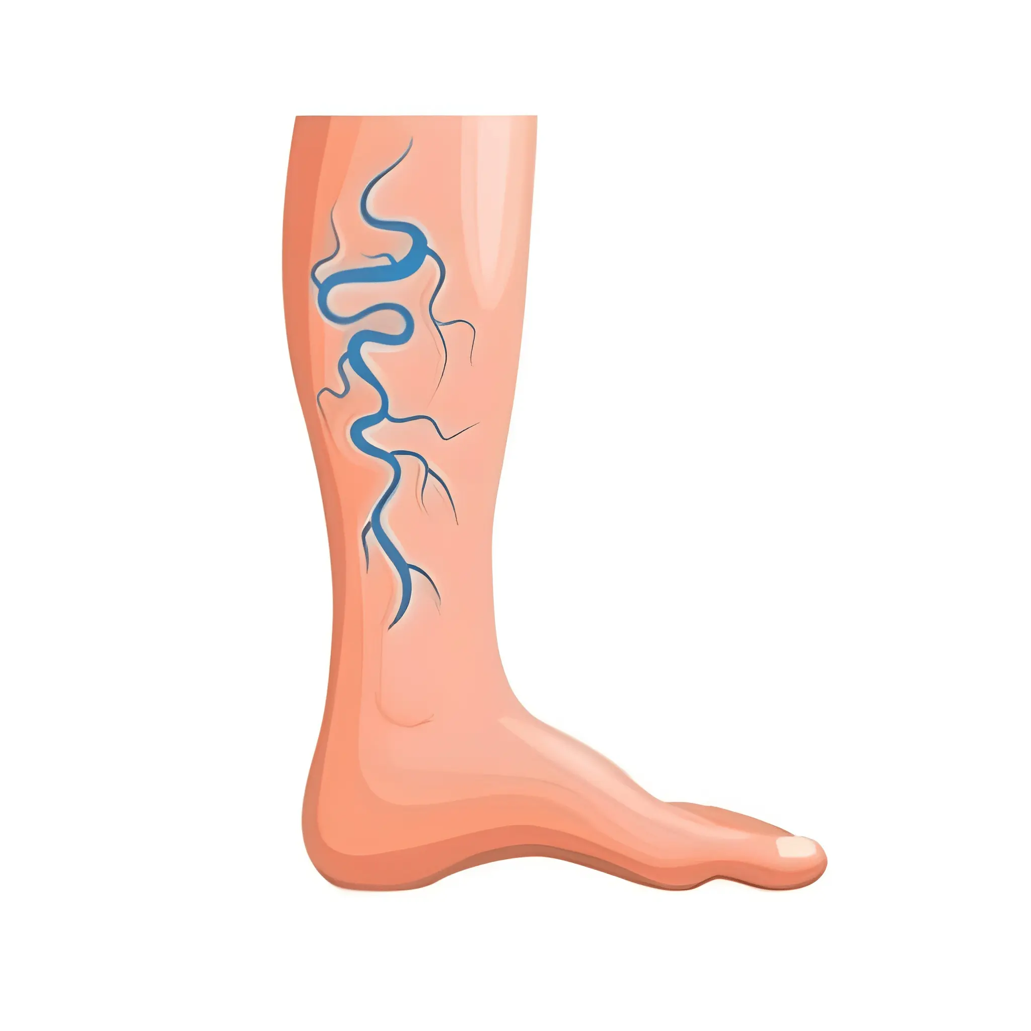 رگ واریسی varicose veins