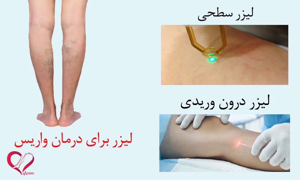 لیزر واریس