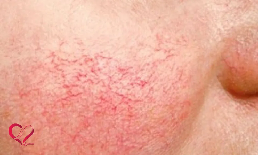 رگهای نازک در روی صورت