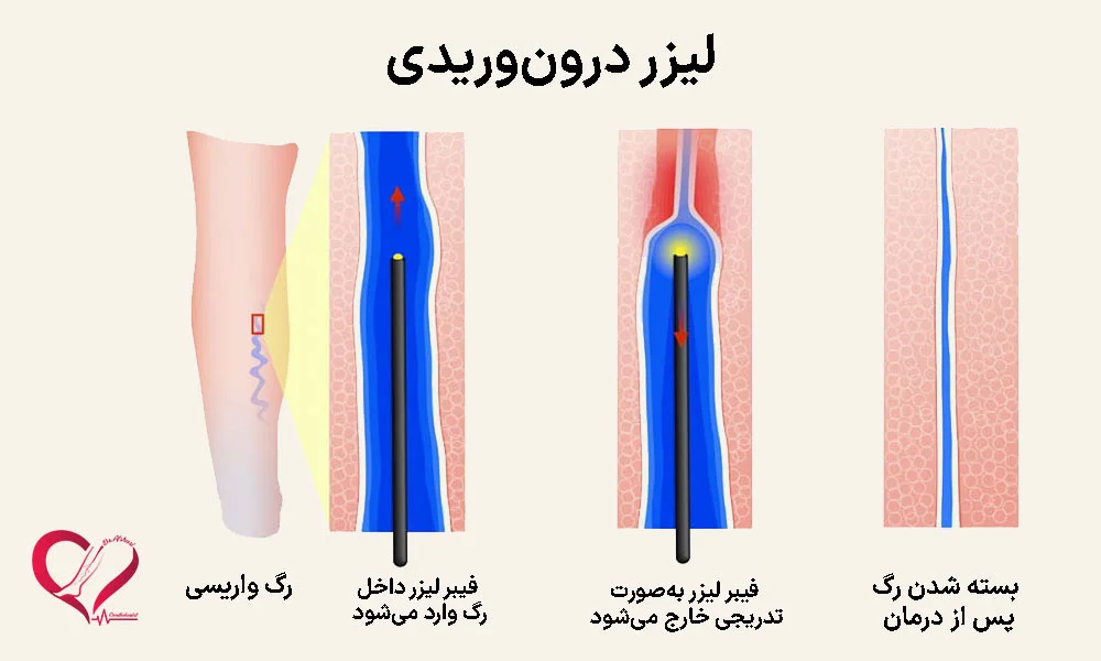 لیزر داخل‌وریدی