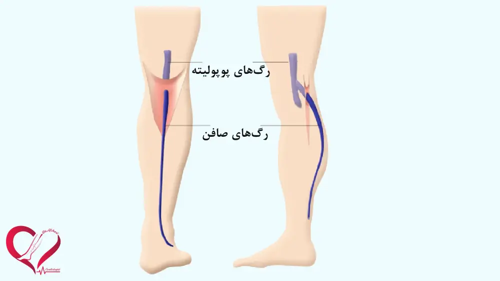 واریس پشت زانو
