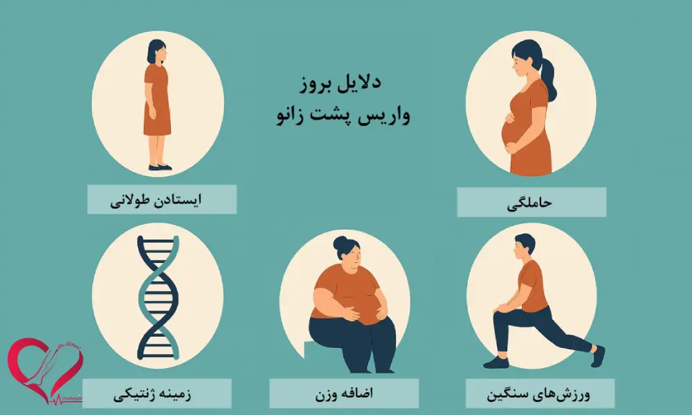 دلایل بروز واریس پشت زانو
