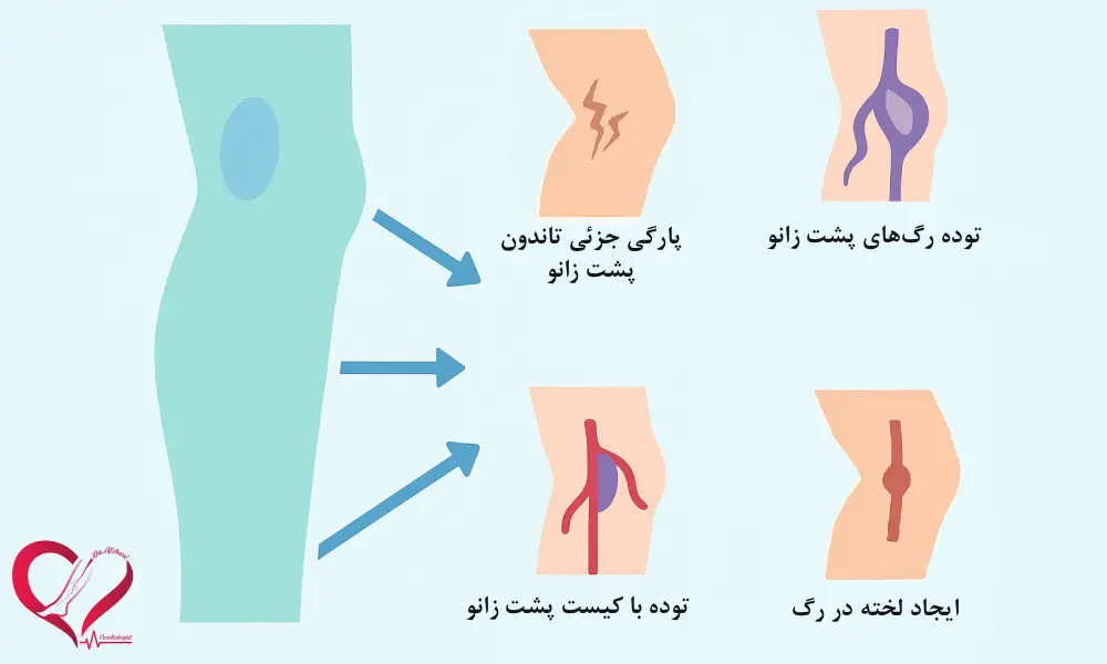 واریس پشت زانو