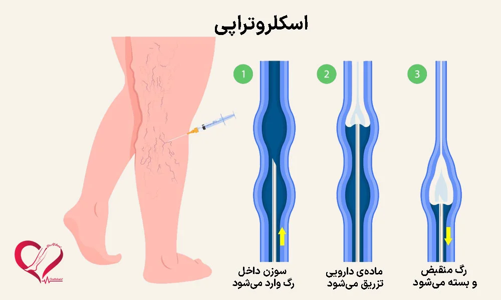 اسکلروتراپی