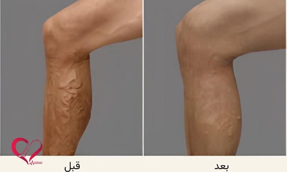 بعد از فلبکتومی، واریس برنمی‌گردد
