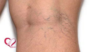 رگهای نازک دست و پا