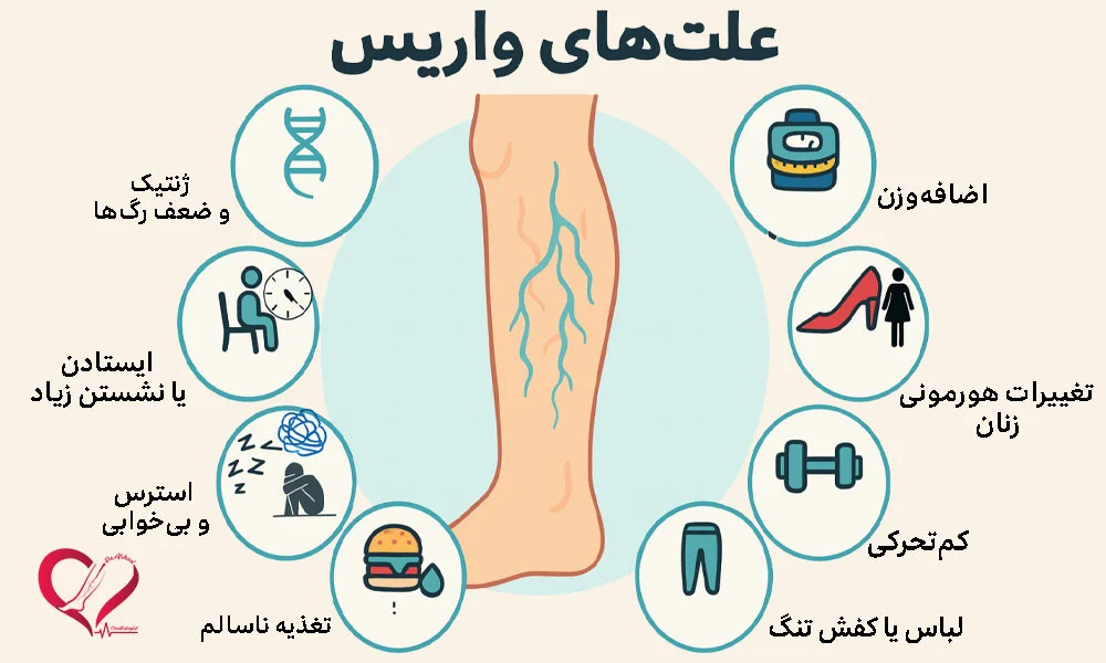 علت واریس