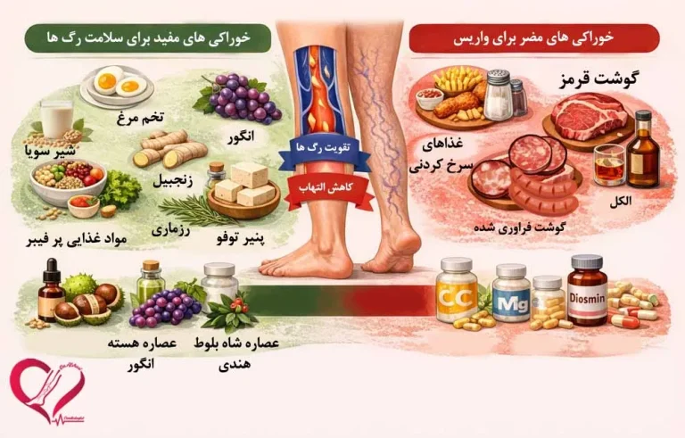 تغذیه واریس