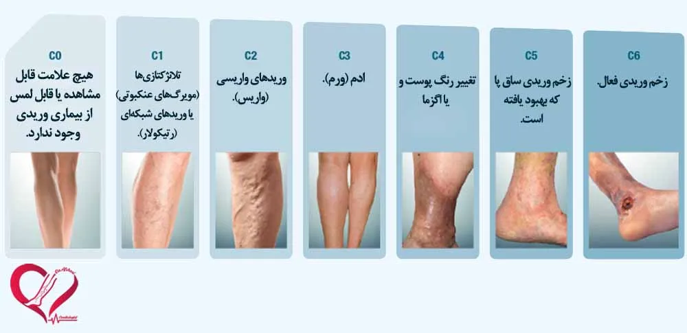 واریس