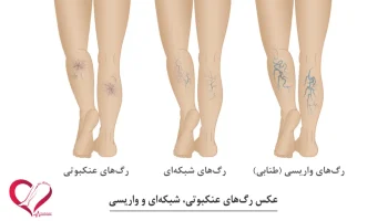 تصویر واریس پا