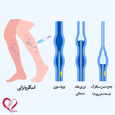 اسکلروتراپی
